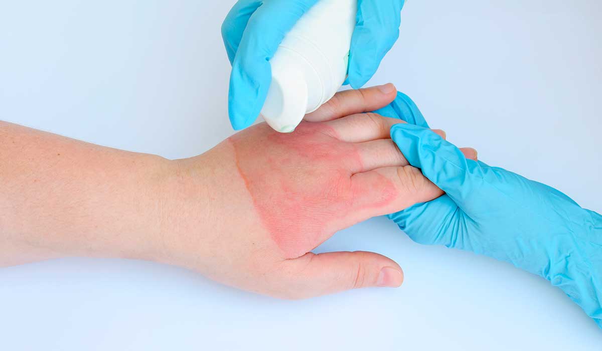 remedios-caseros-para-las-quemaduras